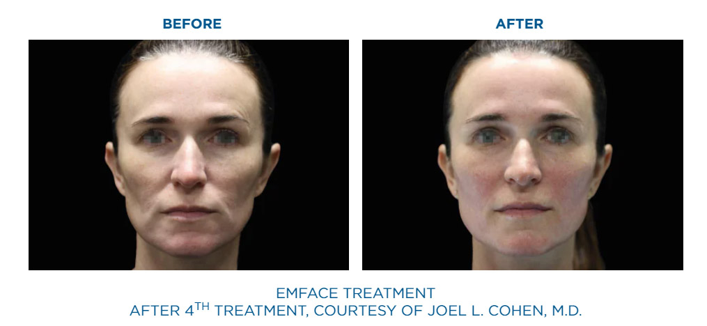 EmFace before and after facial lift result one