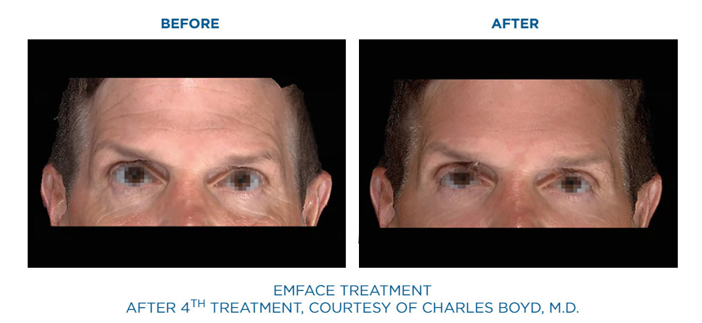 EmFace before and after facial lift result two