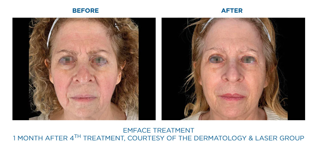 EmFace before and after facial lift result three