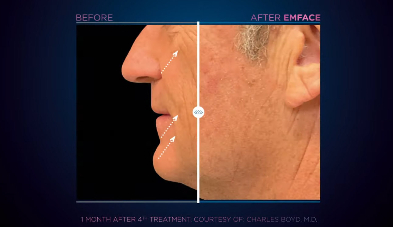 EmFace synchronized radiofrequency and HIFES treatment session