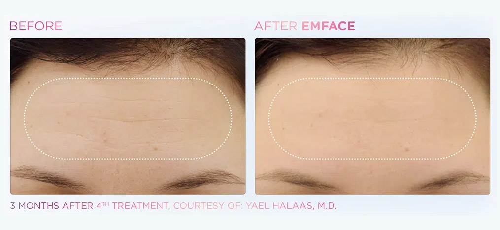 EmFace forehead before and after lift