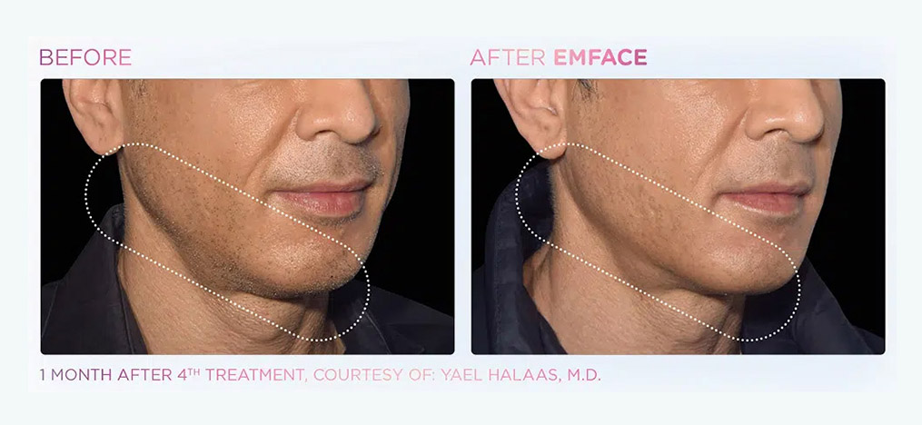 EmFace jawline before and after definition