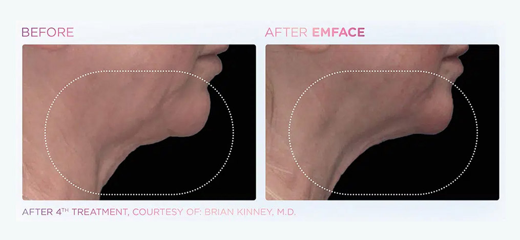 EmFace neck before and after tightening
