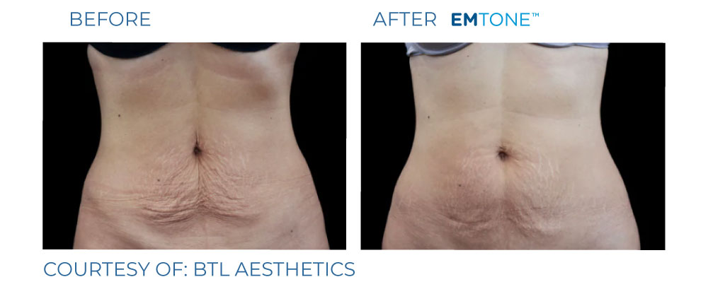EmTone before and after cellulite reduction result one