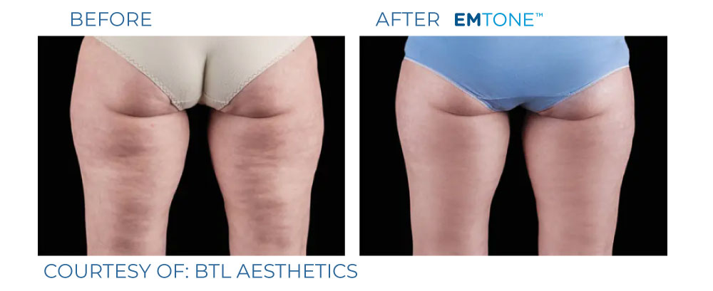 EmTone before and after cellulite reduction result two