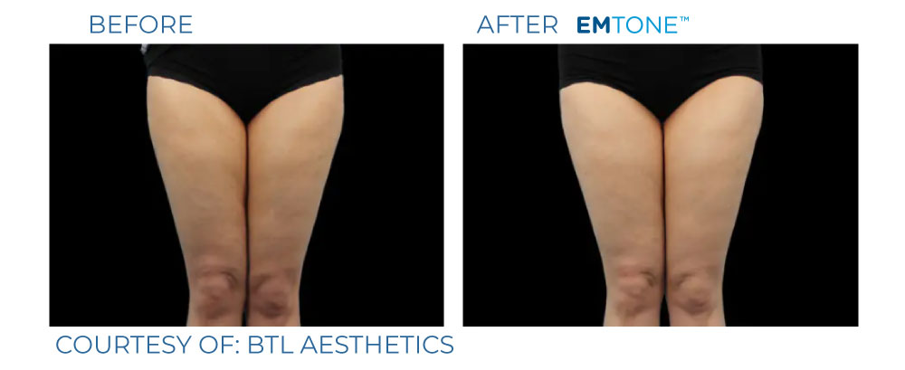 EmTone before and after skin tightening result three