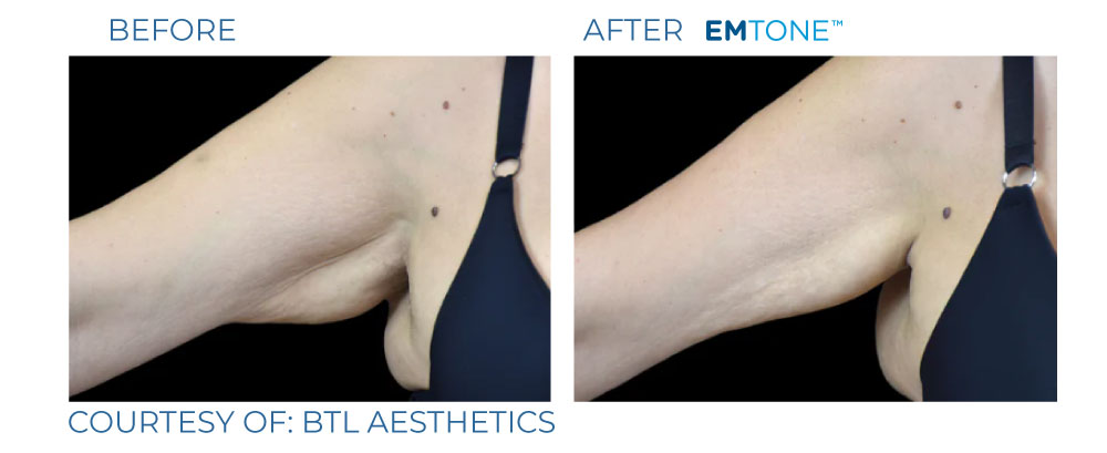 EmTone before and after skin tightening result four