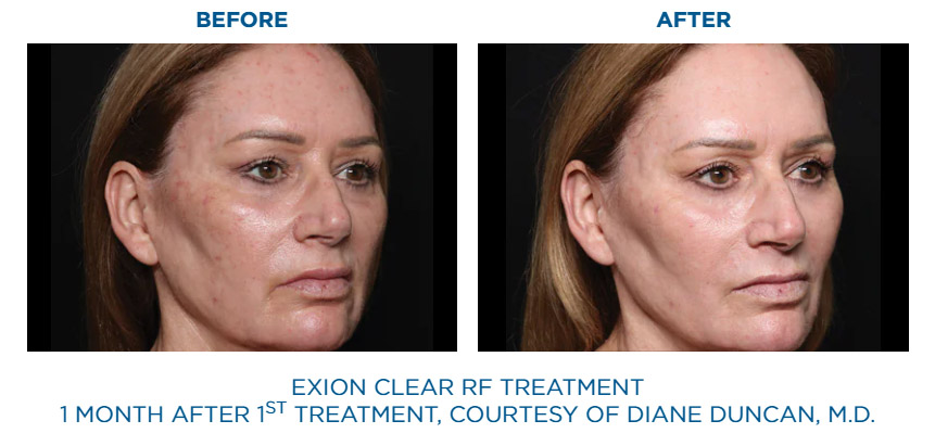 Exion Clear RF skin tone before and after result