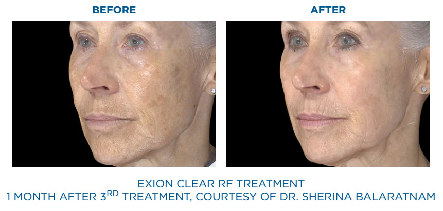 Exion Clear RF before and after skin texture improvement
