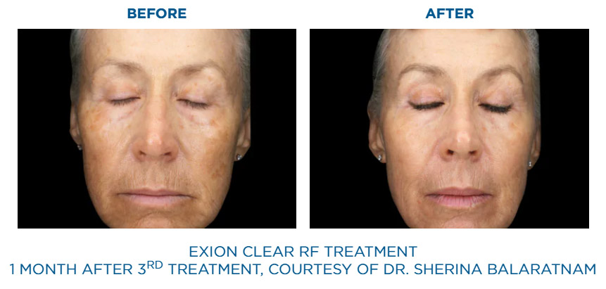 Exion Clear RF before and after skin discoloration improvement