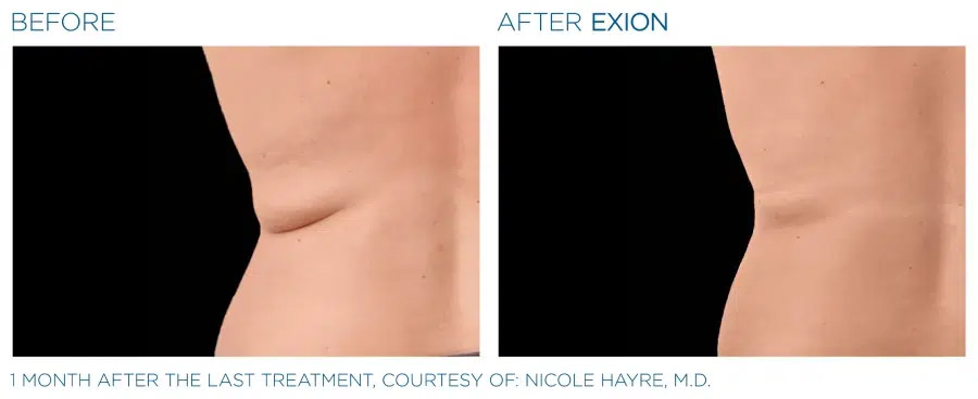 Exion Body before and after body contouring