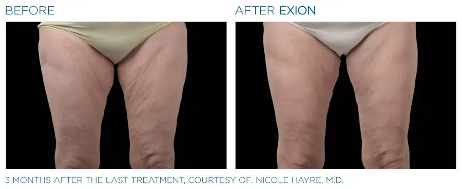 Exion Body before and after fat reduction and skin tightening