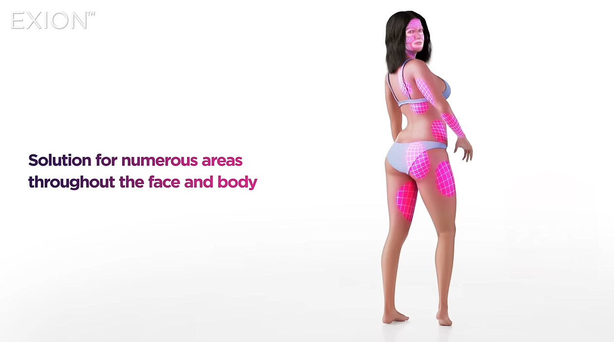 Exion Body contouring treatment session