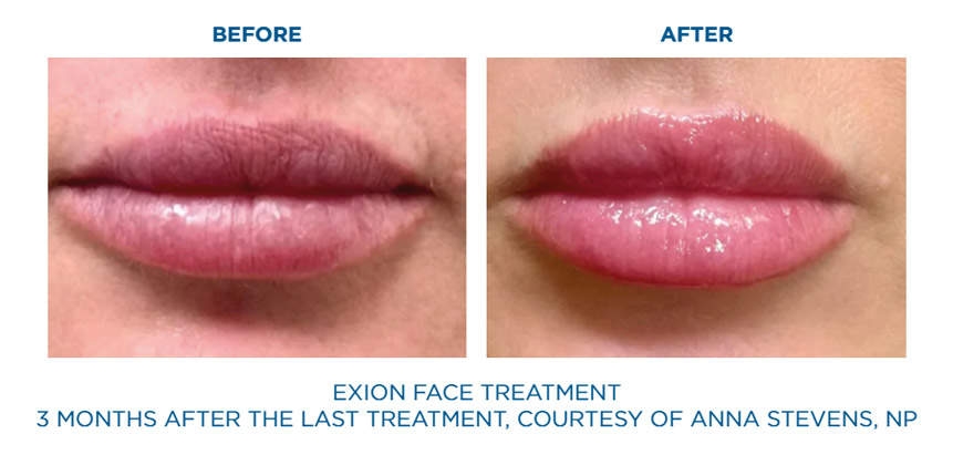 Exion Face before and after wrinkle reduction