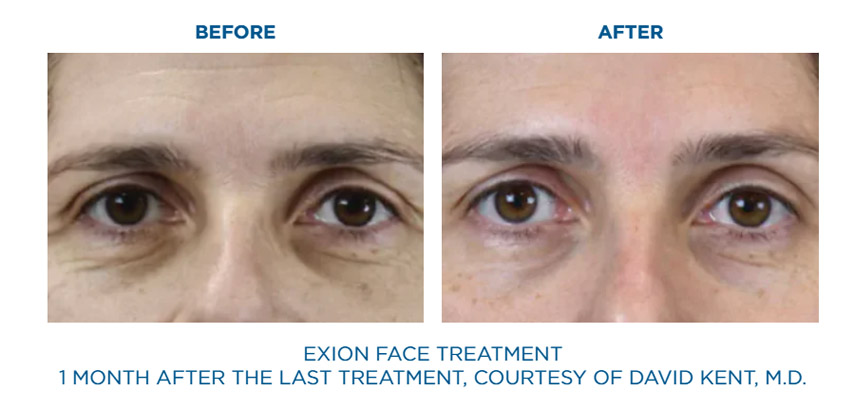 Exion Face before and after facial rejuvenation