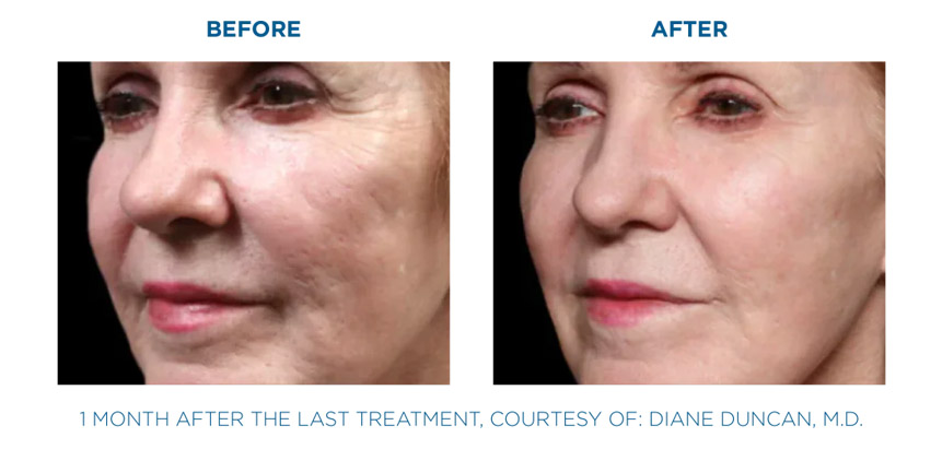 Exion Fractional RF before and after skin rejuvenation