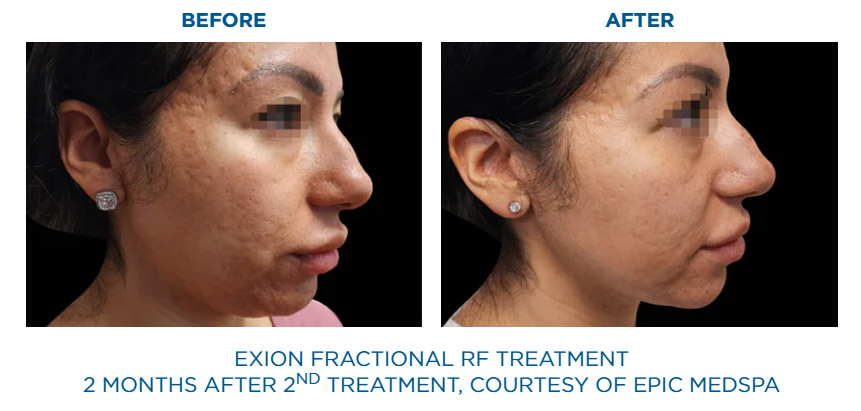 Exion Fractional RF before and after skin tightening